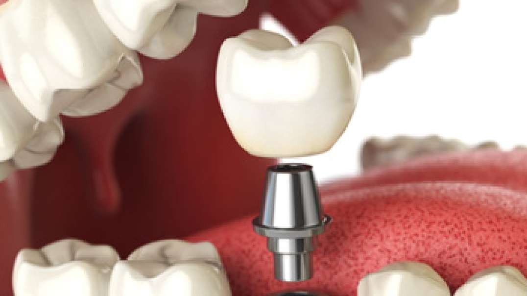 DB Dental Care : Dental Implant in Miami, FL : 33165